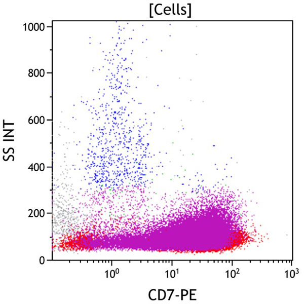 ClearLLab 10C, Case 18, CD7 vs Side Scatter, all viable cells