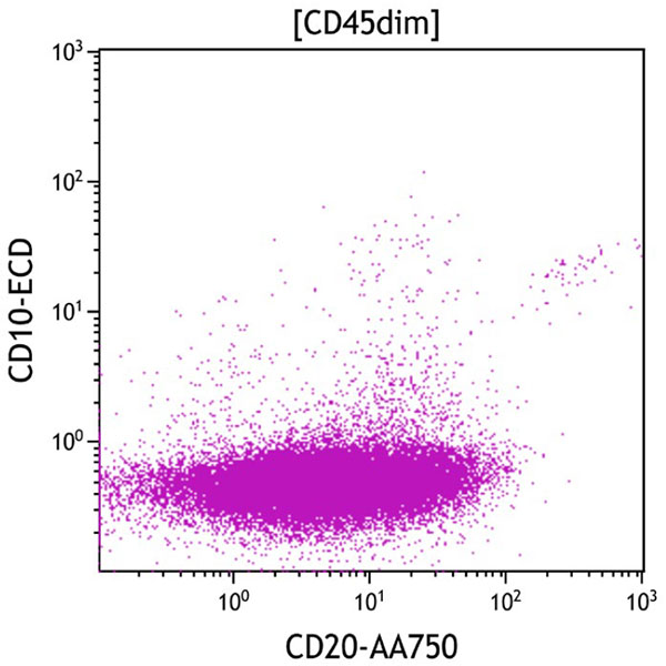 ClearLLab 10C, Case 4, CD20 vs CD10 dot plot, CD45dim gate
