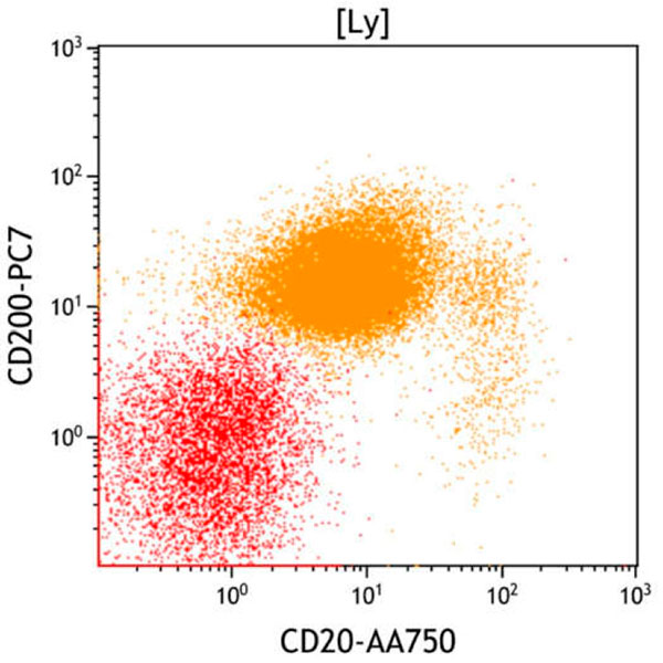 ClearLLab 10C, Case 7, CD20 vs CD200 dot plot, lymphocyte gate