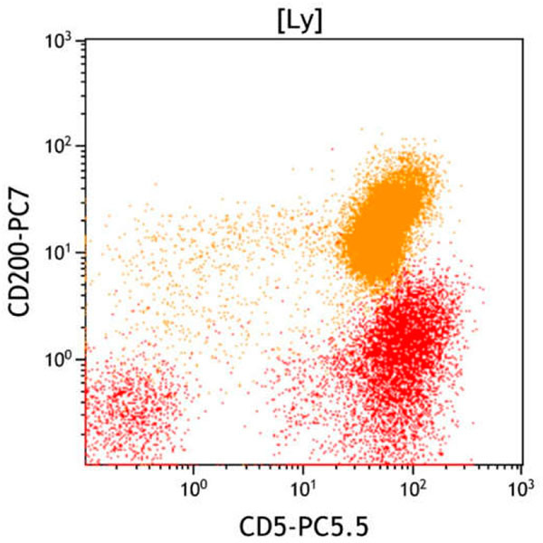 ClearLLab 10C, Case 7, CD5 vs CD200 dot plot, lymphocyte gate