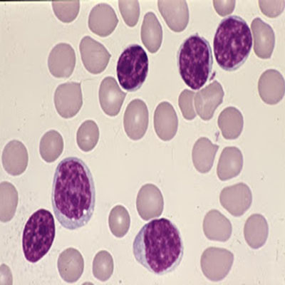 Chronic lymphocytic leukaemia showing mature small lymphocytes
