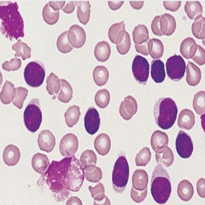 Chronic lymphocytic leukaemia showing evidence of smudge cells in the abnormal bunching.