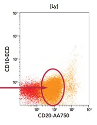Phenotyping profile CD20 vs CD10