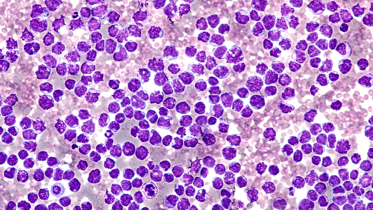 Flow Cytometry Mantle Cell Lymphoma