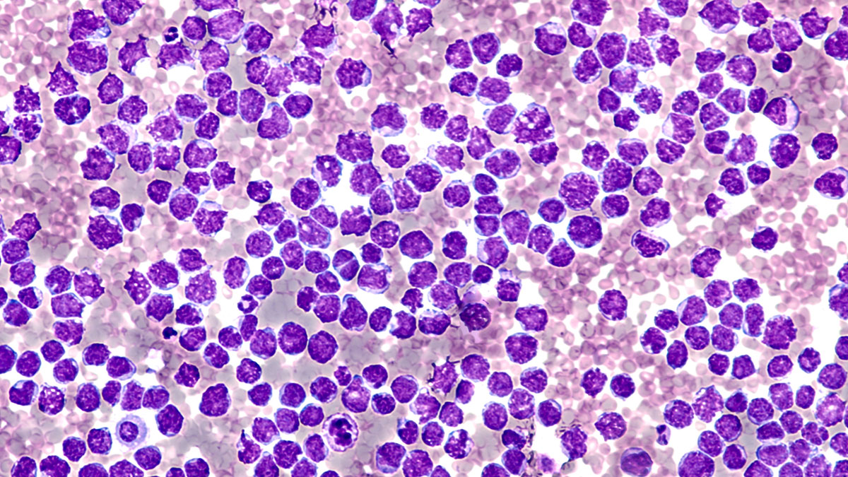 Example micrograph of a Mantle cell lymphoma
