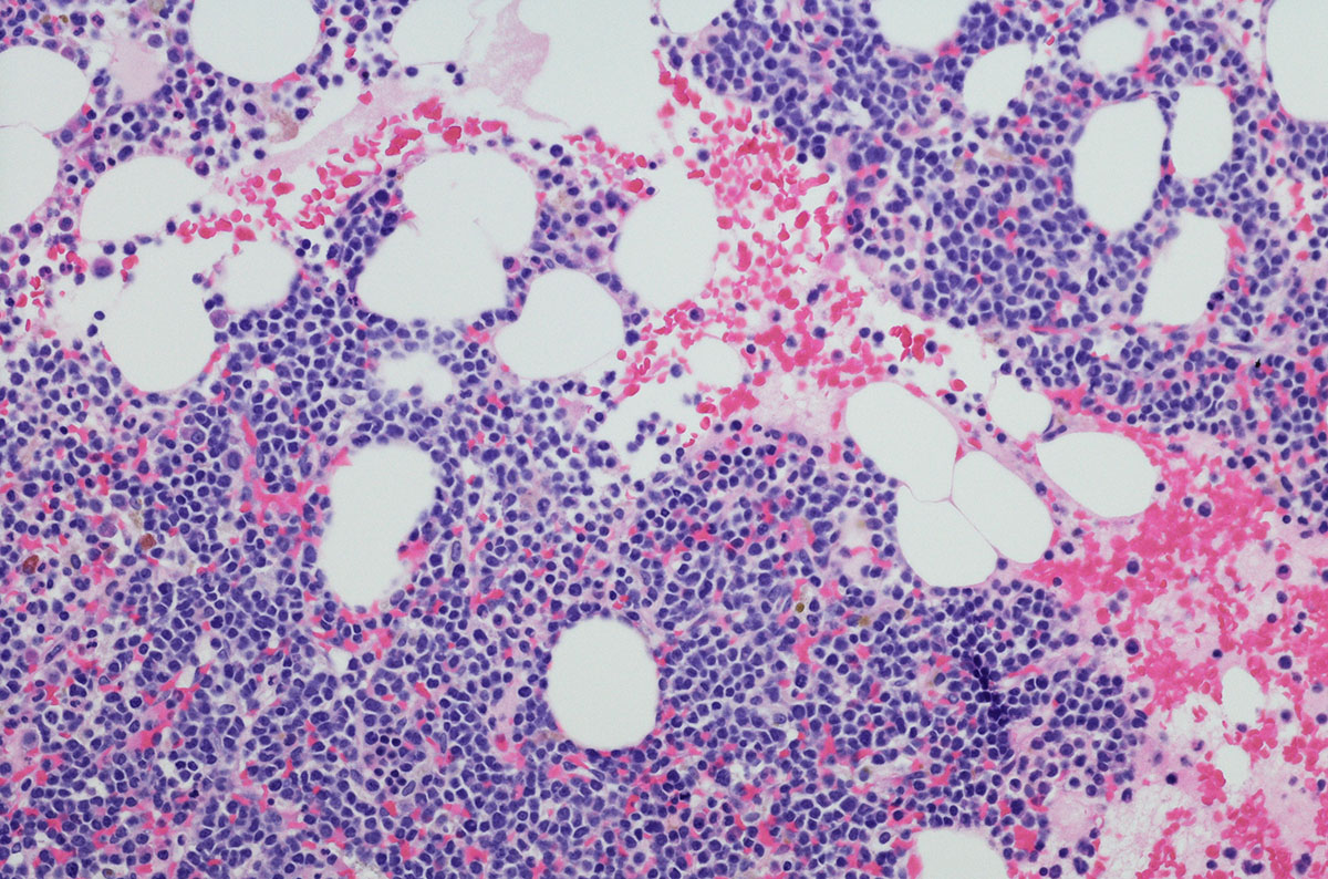 Plasma cell neoplasms