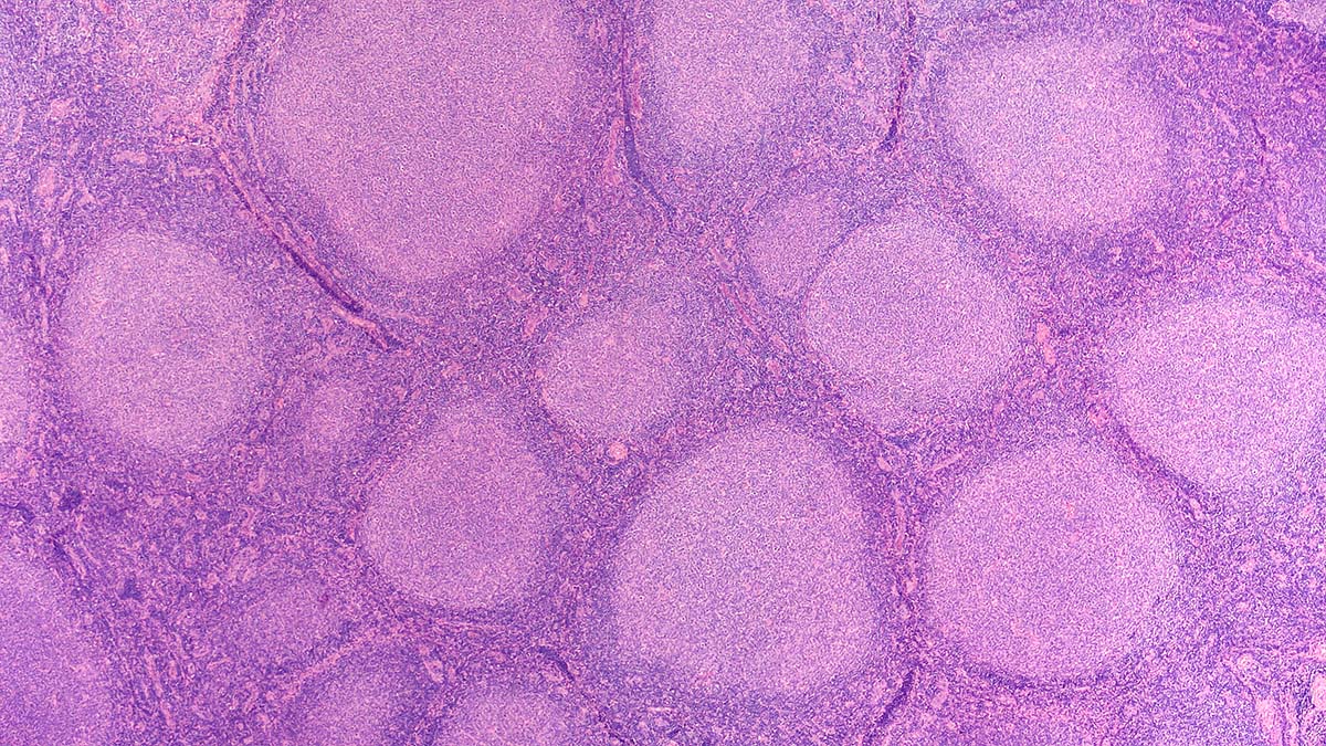 Follicular Lymphoma