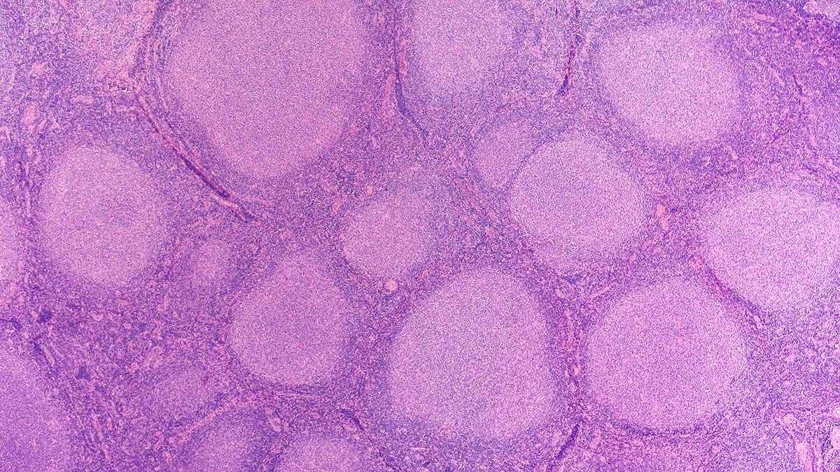 Example micrograph of follicular lymphoma