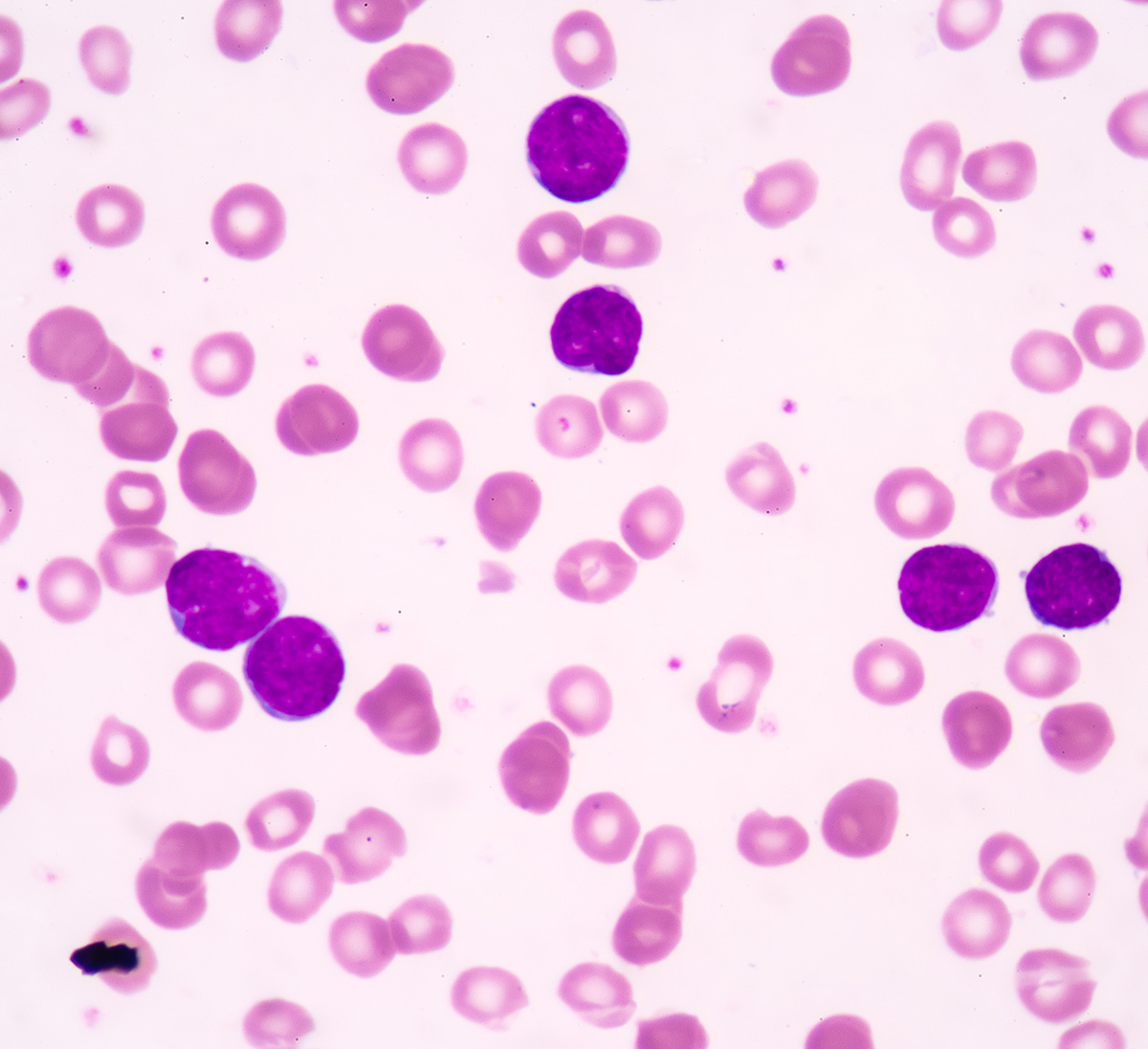 T cell acute lymphoblastic leukemia