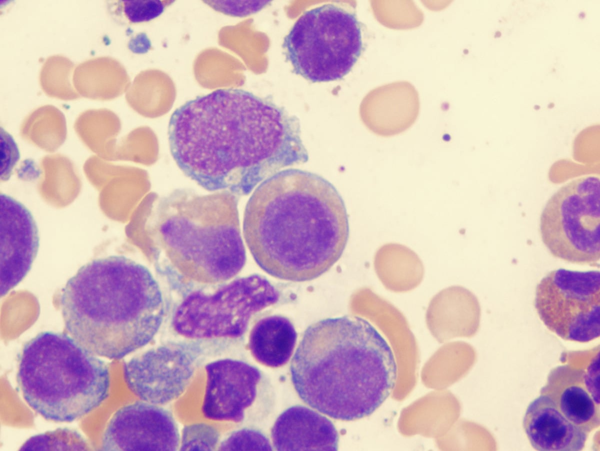 Myelodysplastic Syndrome