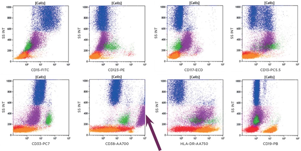 Patient sample immunophenotyping results using ClearLLab 10C M2 Cell Tube, figure 4