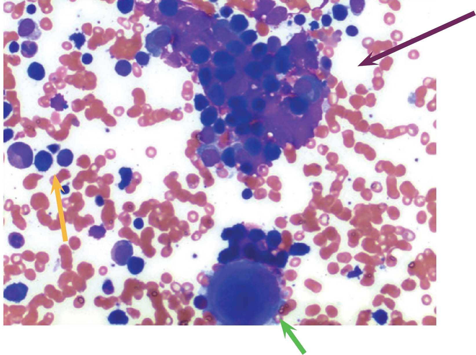 H&E stain of bone marrow aspirate showing mainly small lymphocytes (orange arrow) and clumps of possible plasma cells (purple arrow). Cell at bottom center is a megakaryocyte (green arrow).