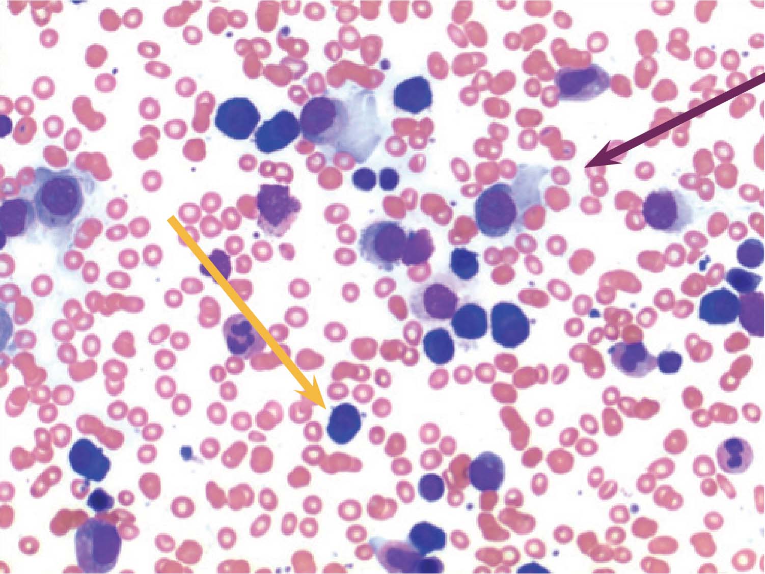 H&E stain of bone marrow aspirate High power field (x100). Small lymphocytes (orange arrow) and plasma cells (purple arrow) are clearly seen.