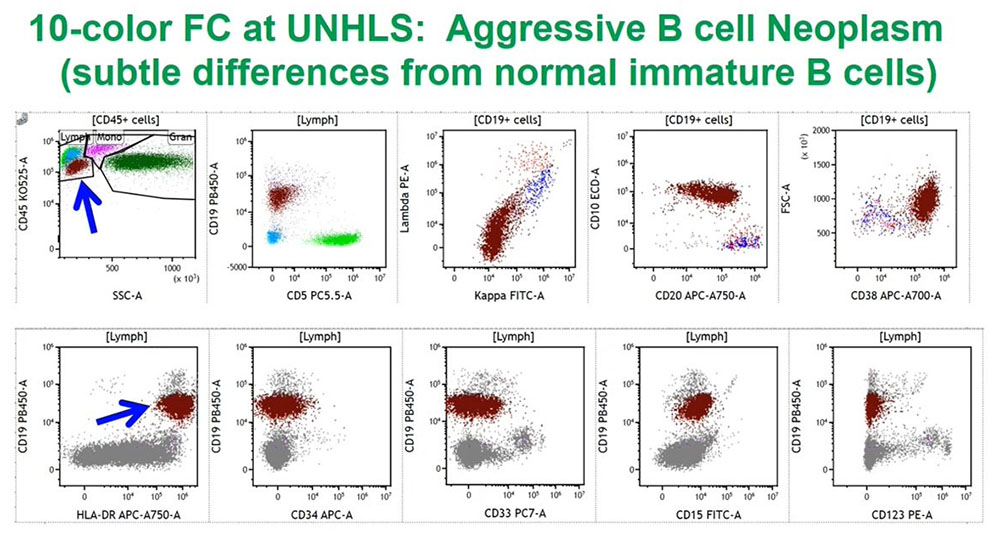 10-color FC at UNHLS: Aggresive B cell Neoplasm