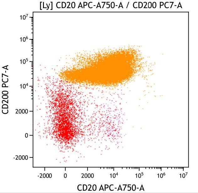 Casebook ClearLLab 10C, case 2, illustration B21, CD20 vs CD200, gated on Lymphocytes