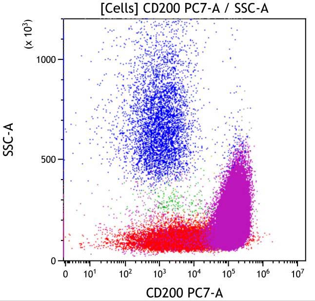 Casebook ClearLLab 10C, case 3, illustration B11, CD200 vs Side scatter, gated on Cells