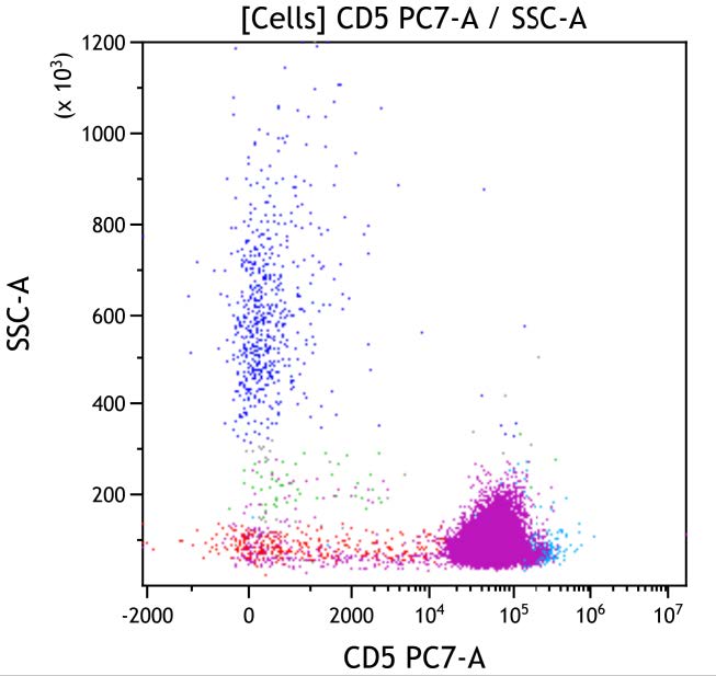 Casebook ClearLLab 10C, case 5, illustration T11, CD5 vs Side scatter, gated on Cells