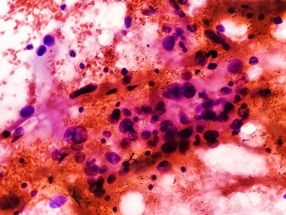 Spindle Cell Sarcoma Cytology